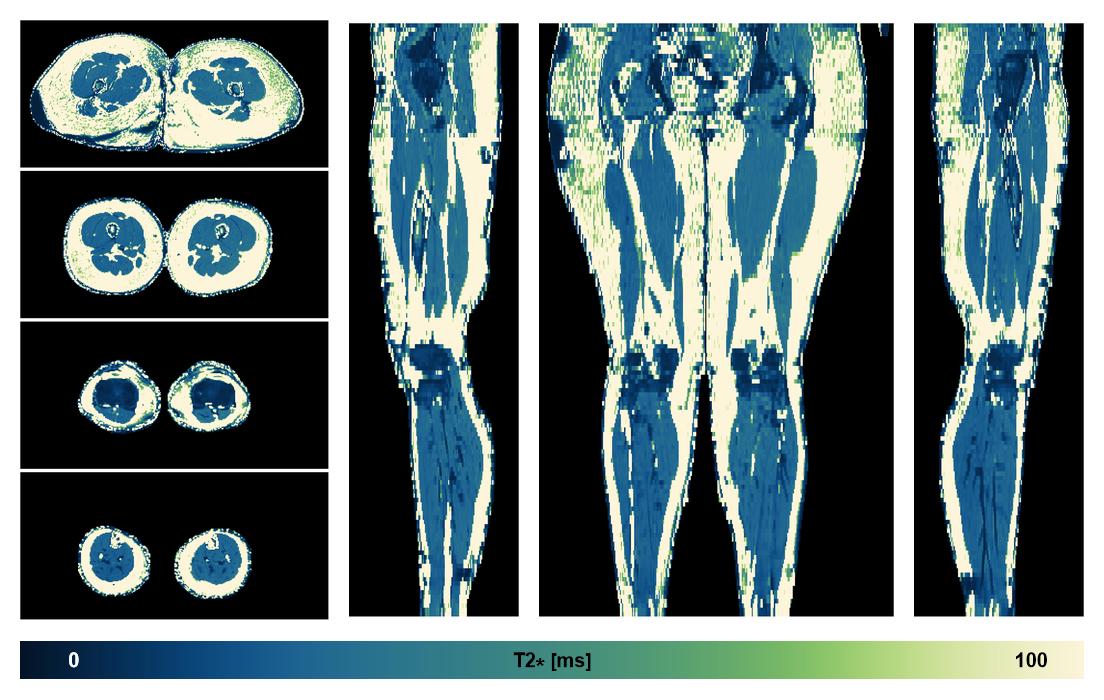 The T2 star relaxation time of the lower extremity obtained from the dixon reconstruction for muscle water fat quantification.